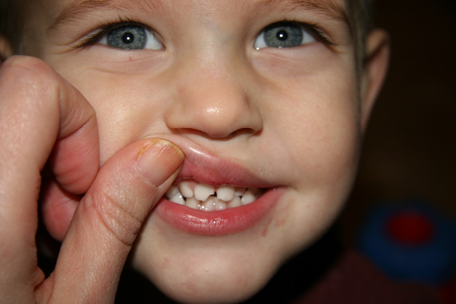 Tommy Chipped a Tooth