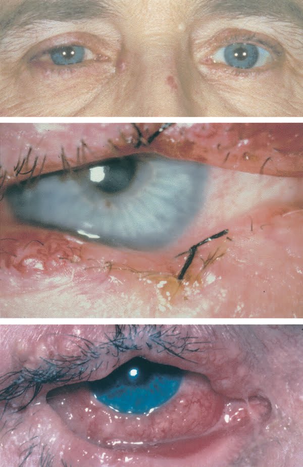 mites symptoms image gallery eyebrow bugs mites symptoms image gallery eyebrow bugs