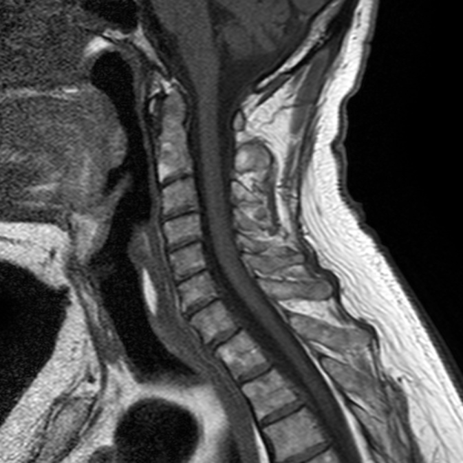 Cervical Mri