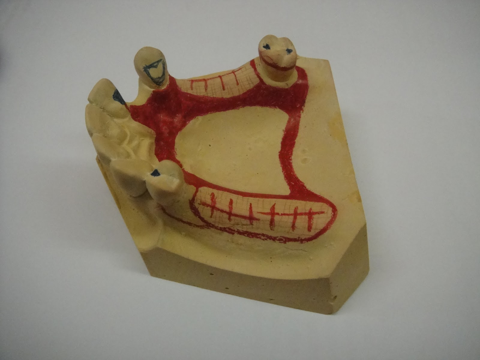 StuDENT Diaries Removable Partial Denture Design