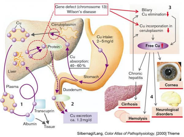 Hepatolenticular Degeneration
