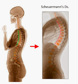 Medical Media Images Blog: What is Scheuermann's Disease?
