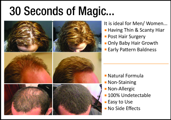 Hair Loss Solution Hair Loss Solution Trendz Volumizer