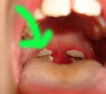 Treatment Tonsil Stones Bad Breath : Tonsillolith Or Tonsil Stone - A Smelly Lump Coughed Up From Your Tonsils_