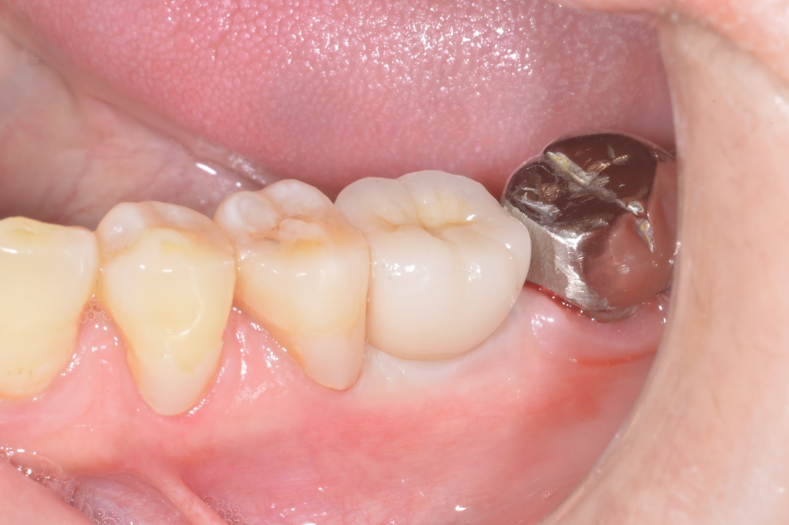 New technique Flapless Crest Splitting for a mandibular narrow ridge