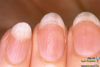 أظافرك تعبر عن حالتك الصحية Nails+(4)