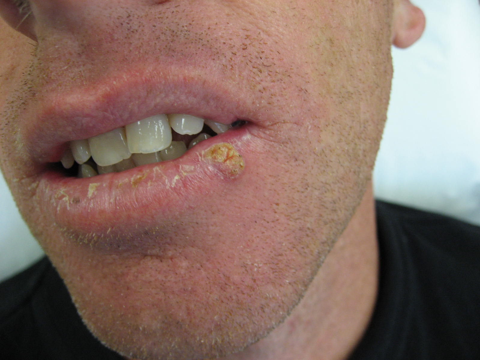 Dermatology For Dentists and Dental Students Lips