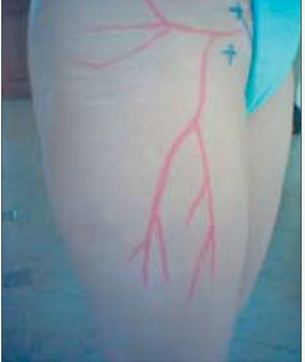 infiltration canal carpien technique