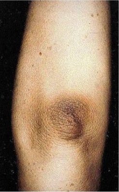 addisons disease skin addisons disease skin
