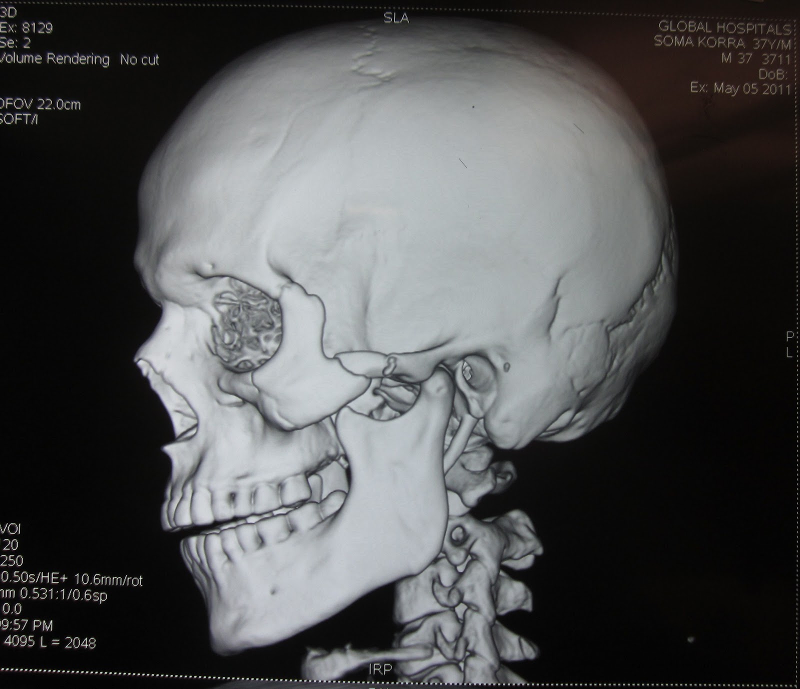 SEGMENTAL FRACTURE ZYGOMATIC ARCH WITH FRACTURE ZYGOMA. ORIF FRACTURE