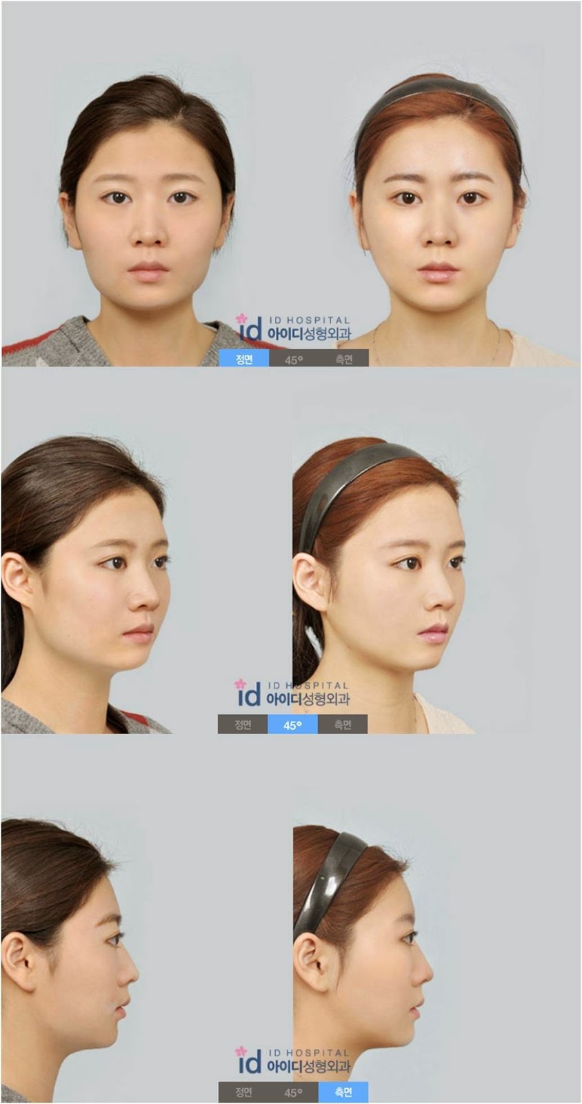 ID Hospital Korea V line surgery before and after photos