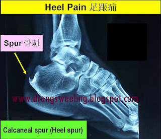 Inferior Calcaneal Spur