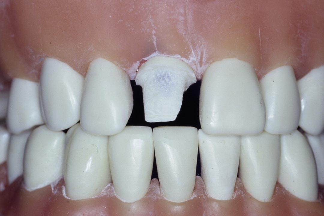 Dentistry Custom Cast Dowel Core