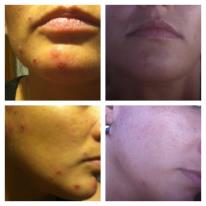 get sassy with it works global products use of defining gel in so it works greens acne