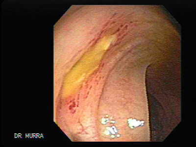 foods to avoid with diverticulitis