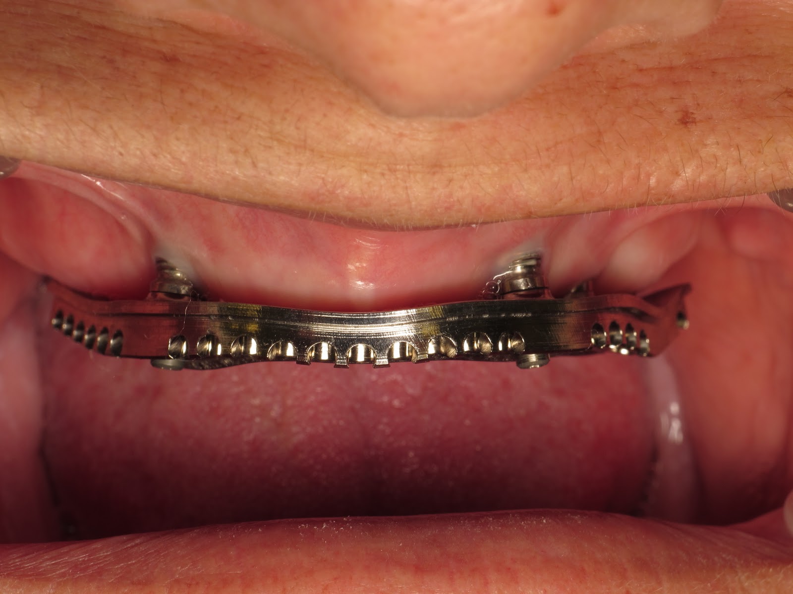 All Things Dentistry Episode 228/500 Milled Titanium Bar Implant