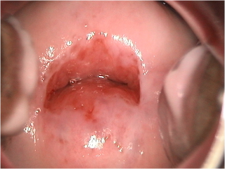 LESIONES EN EL CUELLO UTERINO lesiones en el cuello uterino: