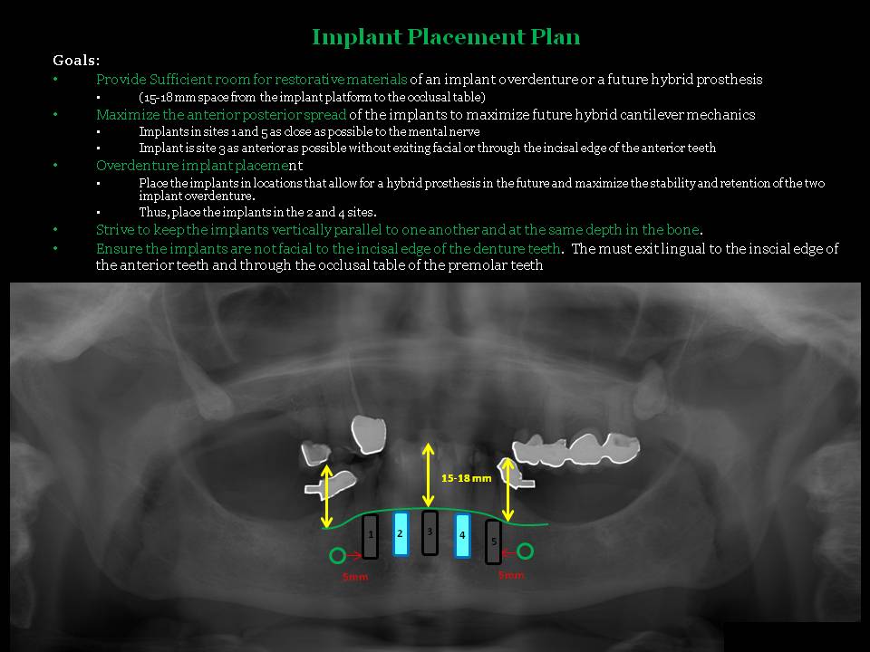 Boise Idaho Prosthodontics Surgical Guidelines for Mandibular 2 Implant Retained Overdentures