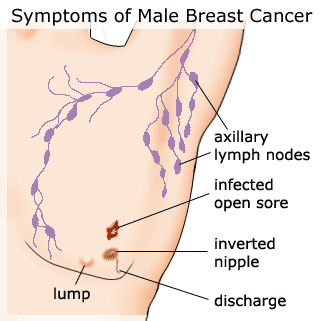 Axillary Lymph Nodes And Breast Cancer Symptoms