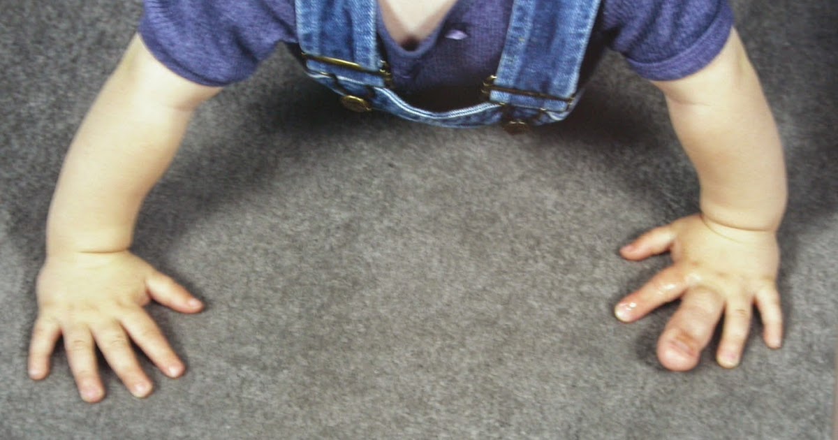 Macrodactyly- Big fingers | Congenital Hand and Arm Differences