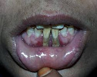Piorrea o periodontitis se refiere a una etapa avanzada de la enfermedad periodontal en el que los ligamentos y huesos que soportan los dientes se inflaman y infectada .