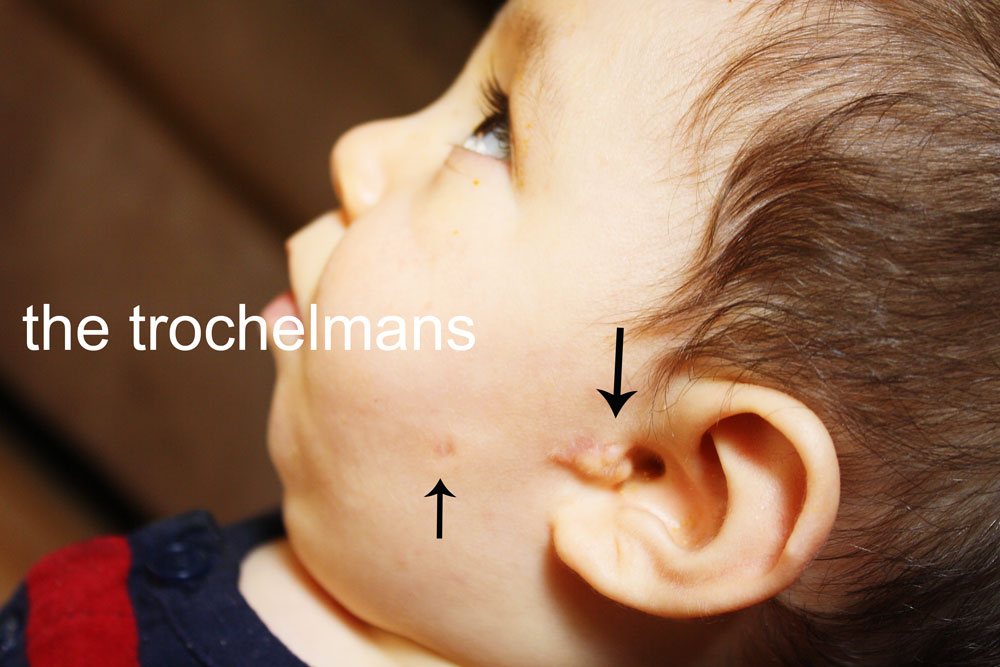 the trochelmans Skin tag removal on our baby