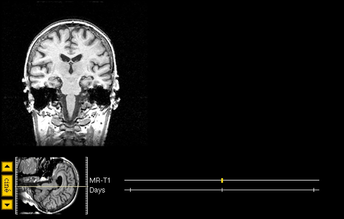 brain aging thesis brain aging thesis