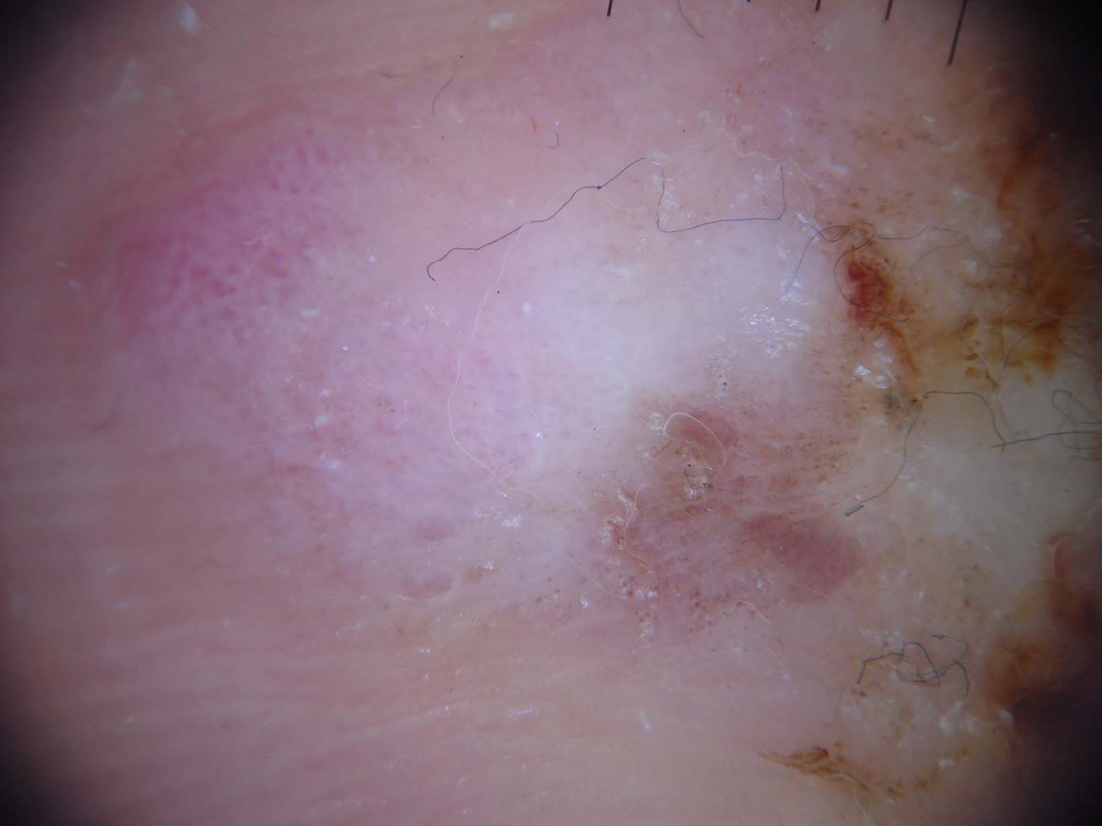 Melanoma On Toenail