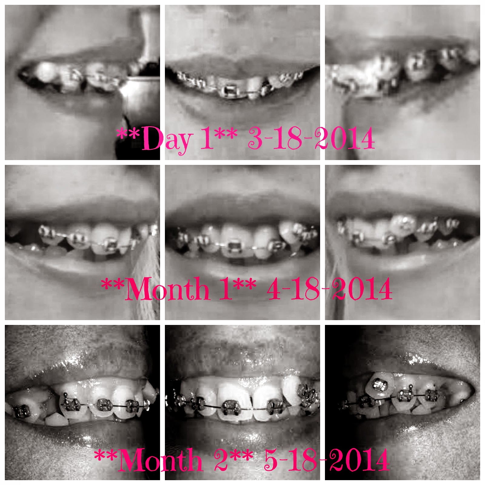 Adult Braces My Journey 2nd Month Update With Braces