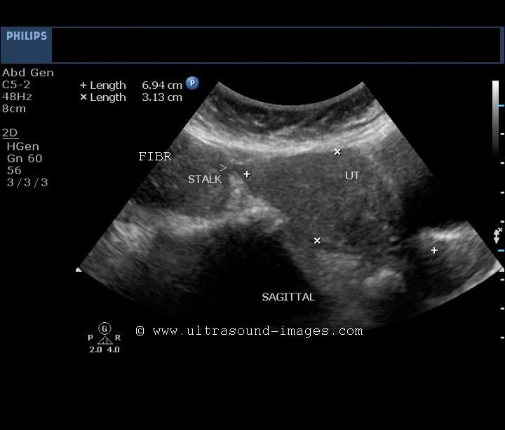 Ultrasound Pedunculated Fibroid