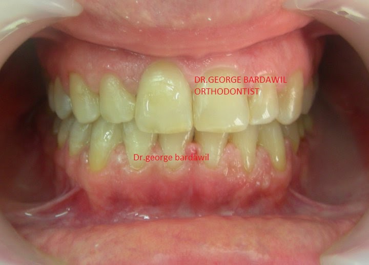 Dr.George E. Bardawil-Orthodontist-Invisalign Diamond level : CLASS 3