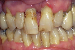 tartar between teeth tartar between teeth