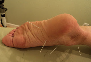 Heel Spurs Relief Using  Acupuncture