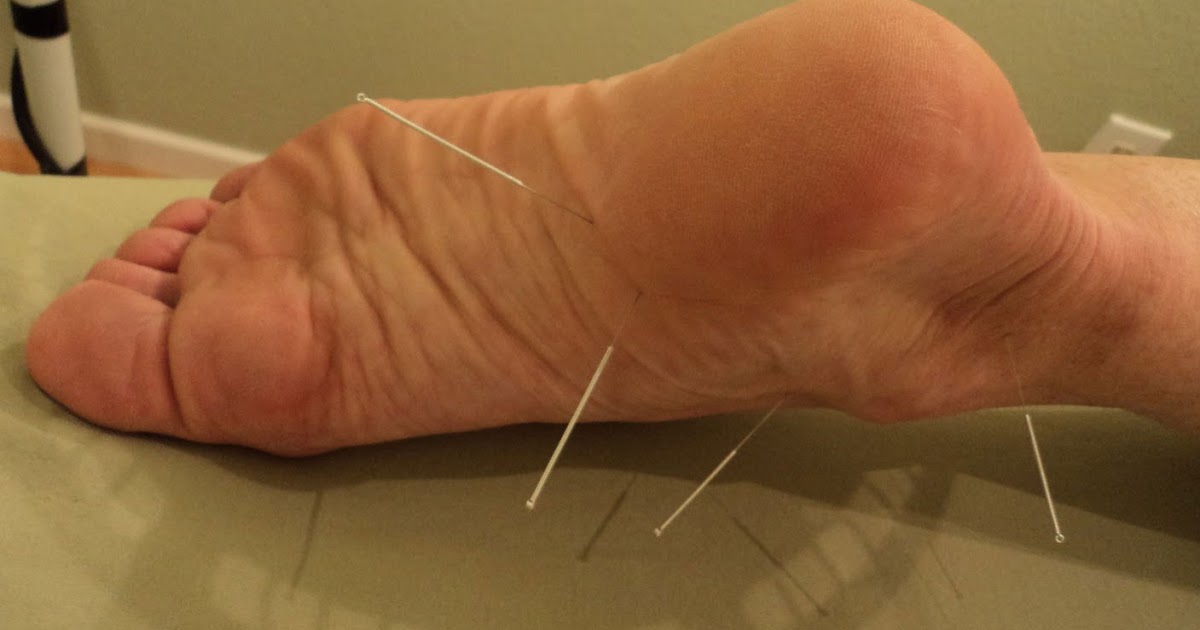 Heel Spurs Relief Using Acupuncture Health and Fitness