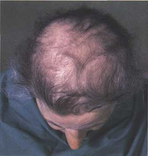 Steroids side effects hair loss