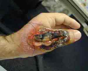 Camel Spider Bite