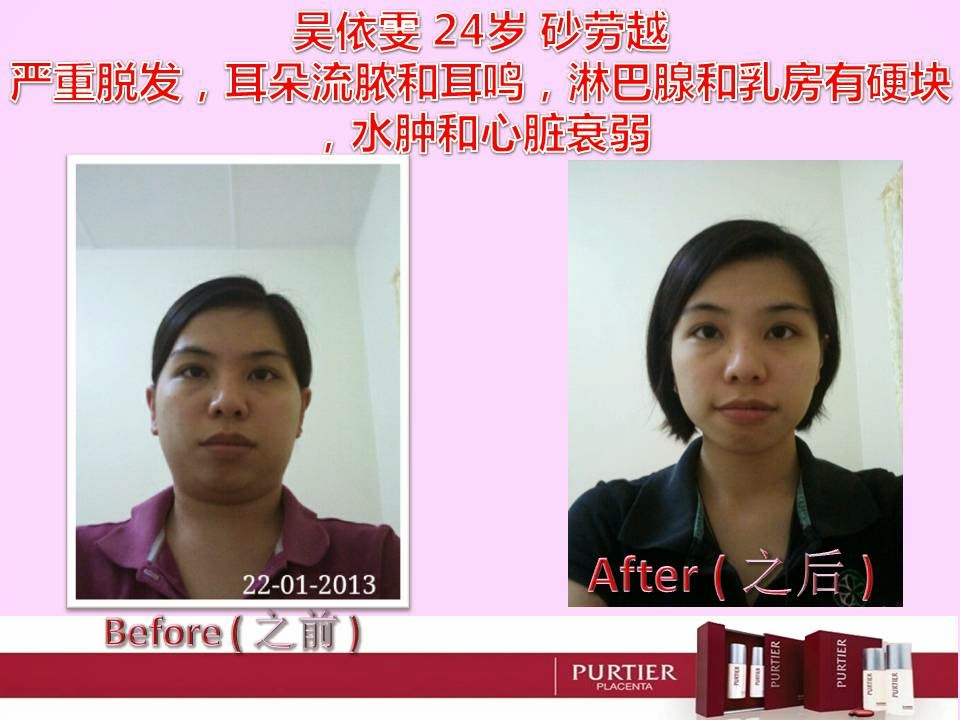 LILIAN (24) SARAWAK-HAIR & EAR DISORDER, LYMPNODE SWOLLEN, WATER RETENTION, HEART PALPITATION