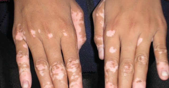 Obat Vitiligo
