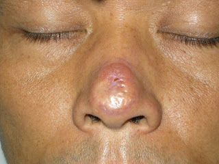 nasal tumor nose tip dermatology rounds virtual grand clinical