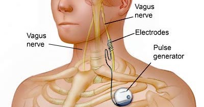 Rayleigh Bug Blog: Vagus Nerve Stimulator