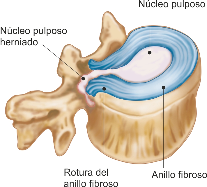 REEDUCACIÓN POSTURAL Y DE MOVIMIENTO HERNIA DISCAL LUMBAR