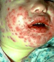 Penyakit Herpes Pada Anak