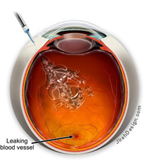 Side effects of steroid injections in the eye