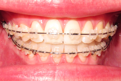months braces teeth days before yellow stained perfect why say finish promise overly nevertheless coming idea keep