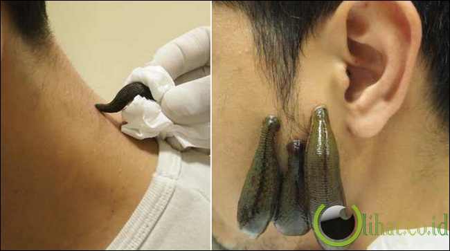 Pengobatan Terapi Lintah Pengobatan Terapi Lintah