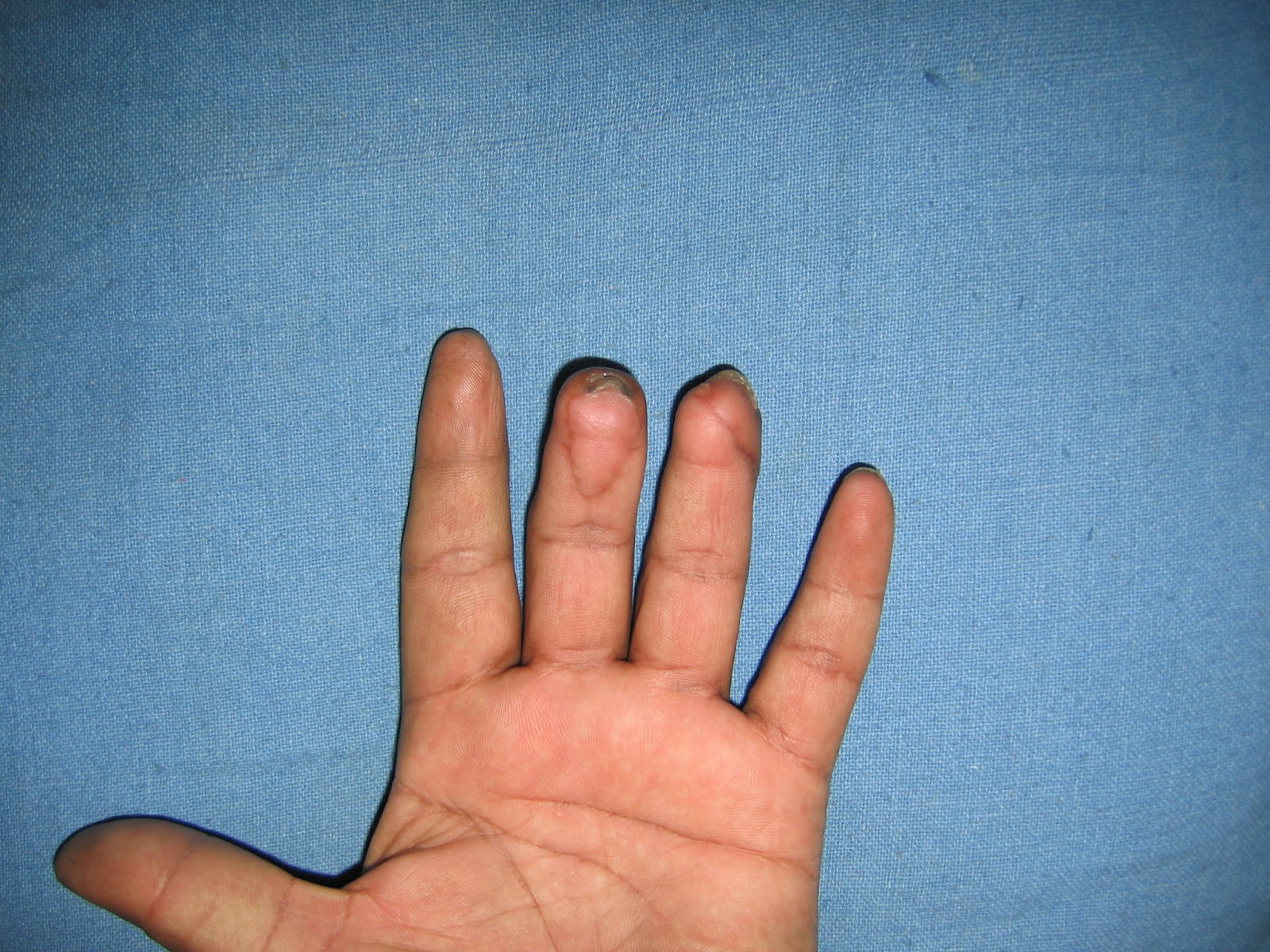 CRUSH INJURIES OF HAND AND UPPER LIMB INJURIES HAND TRAUMA FINGER
