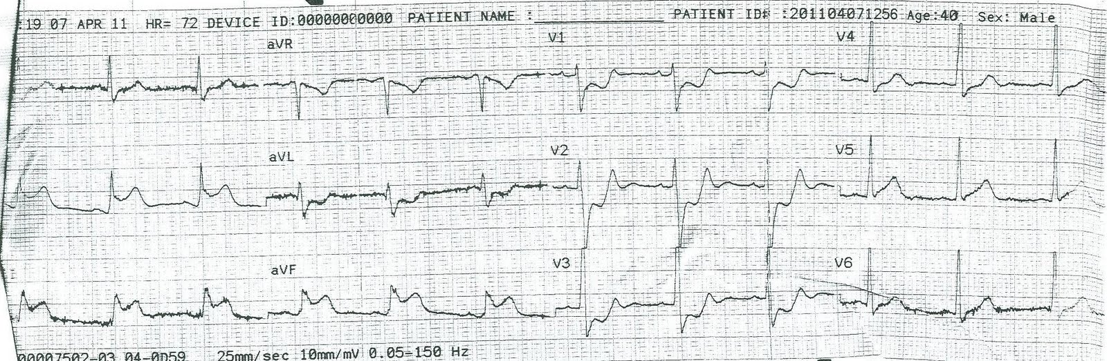 Anterior Stemi Ecg