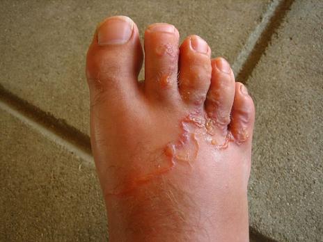 El lavado de los calcetines el hongo de las uñas en los pies