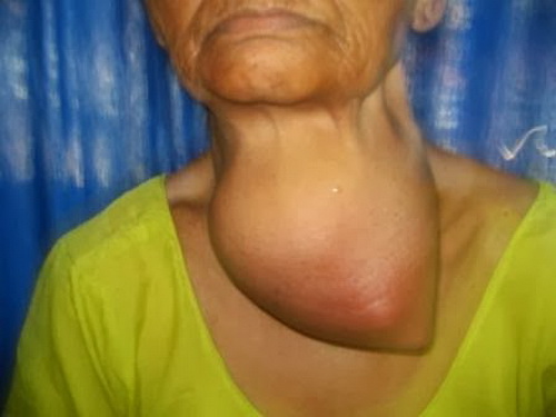 Cutaneous symptoms of zinc deficiency in adults