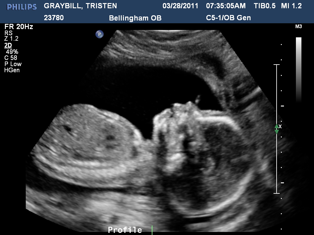 Inside Tristen 20 Week Ultrasound ITS A BOY!!